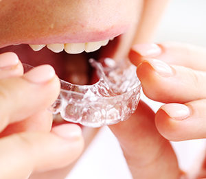 ZALECENIA CLEAR ALIGNER